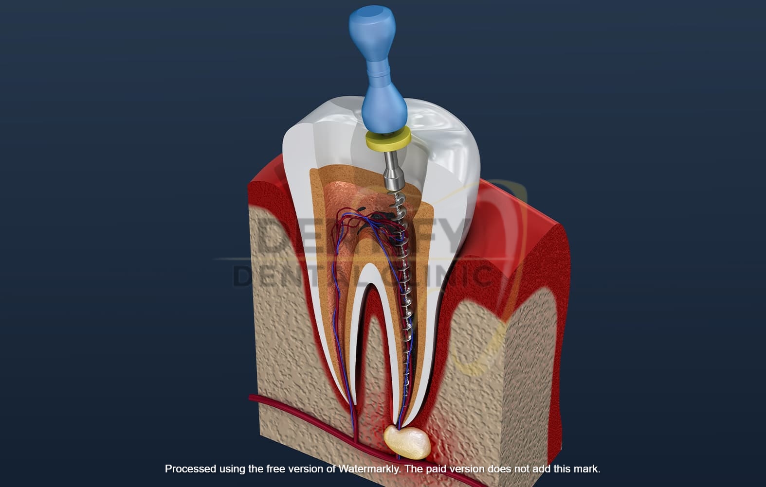 Root canal treatment at Dentify Dental Clinic, best dental clinic in Delhi