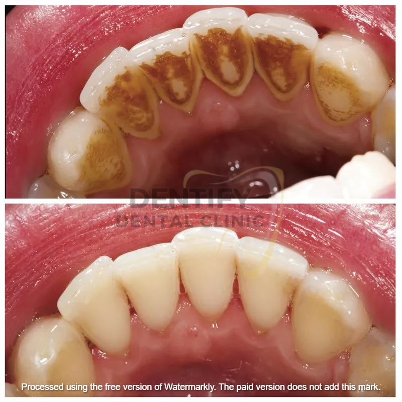 Teeth cleaning at Dentify Dental Clinic, best dental clinic in Delhi