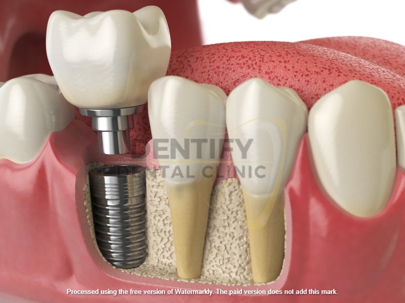 Dental implant treatment at Dentify Dental Clinic, best dental clinic in Delhi
