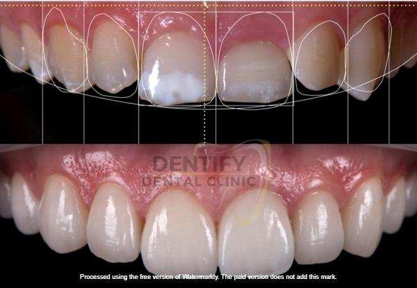 Smile designing at Dentify Dental Clinic, best dental clinic in Delhi