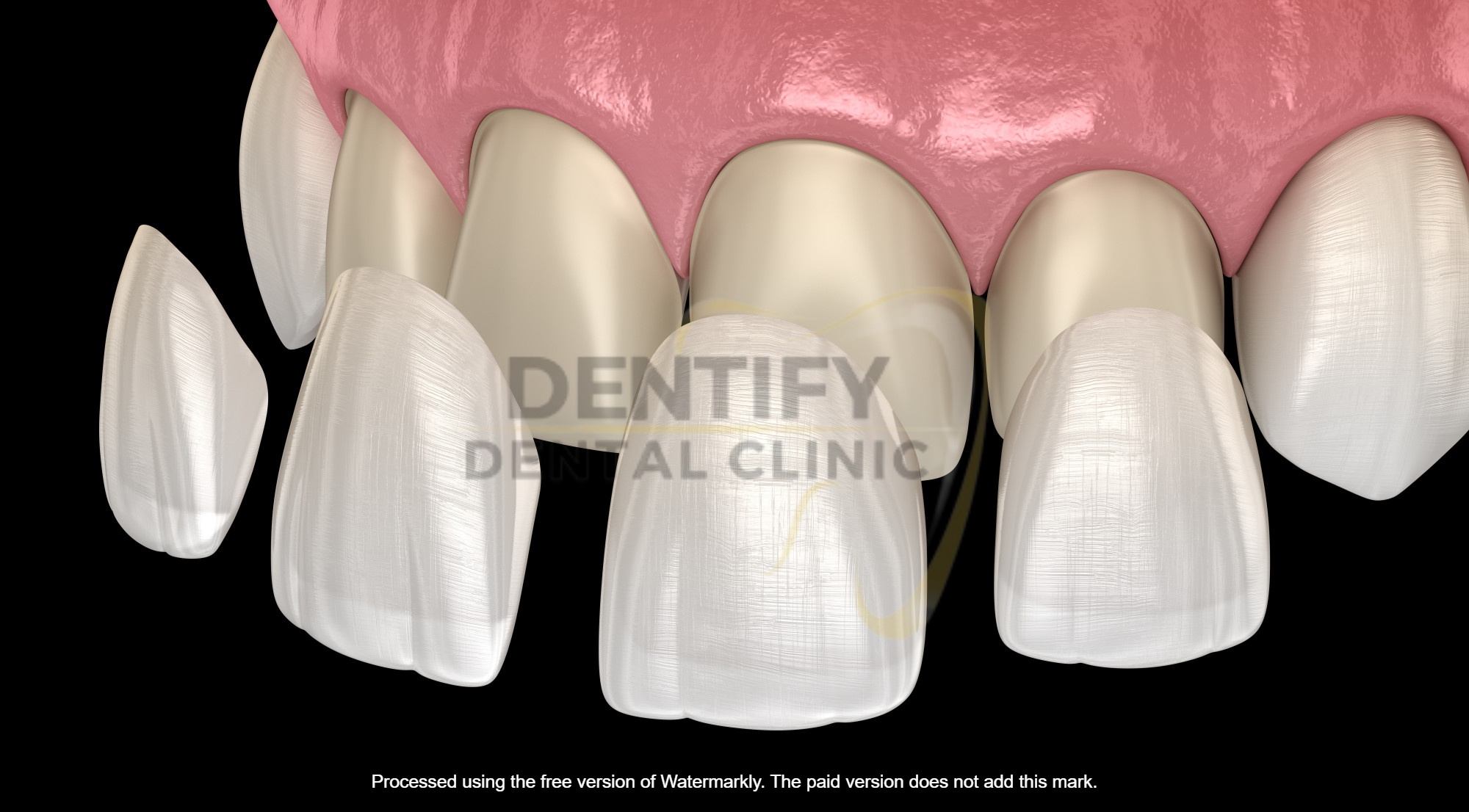 Veneer treatment at Dentify Dental Clinic, best dental clinic in Delhi