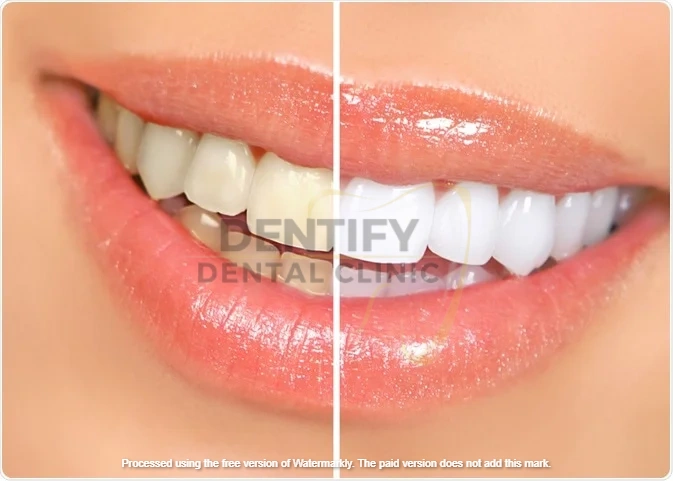 Teeth whitening at Dentify Dental Clinic, best dental clinic in Delhi